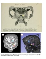 nazca-j-types-skull-analysis-by-a-physician-v0-jy2ogrwqfead1.jpg