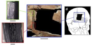 diagramofexcisedbonetrepanationisrael-23065952.jpg